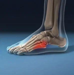 Jones Fractures